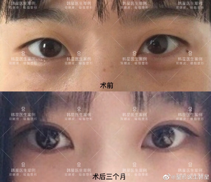 韓星雙眼皮案例