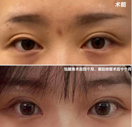 冷靜雙眼皮修復案例