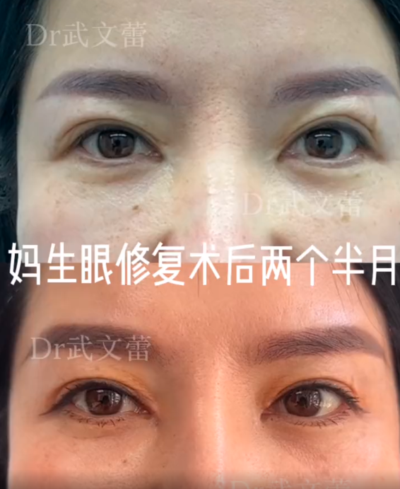 武文蕾眼修復案例