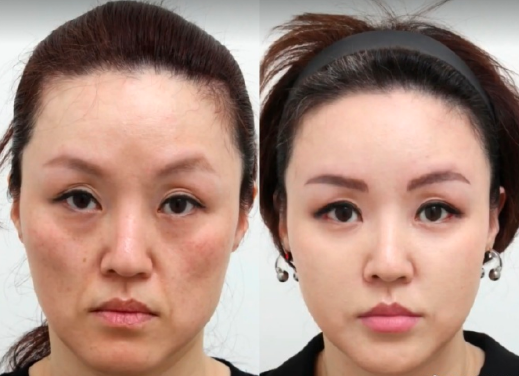 北京張海明做錨定拉皮技術(shù)靠譜嗎