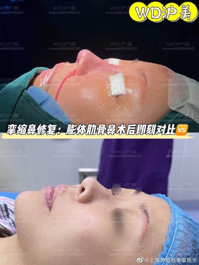 李章鼻修復案例
