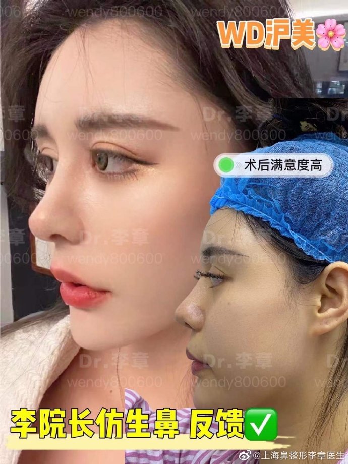 李章鼻修復案例