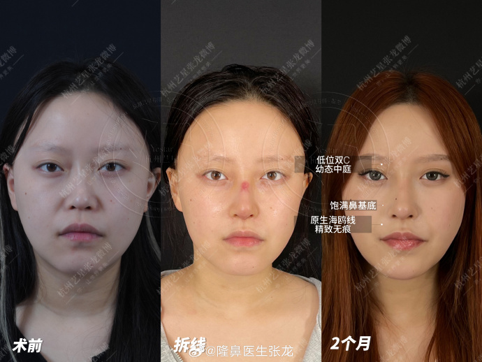 杭州鼻修復(fù)張龍和任東哪個(gè)好？
