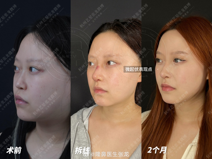 張龍鼻修復案例