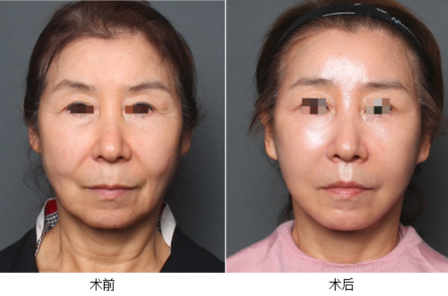 北京拉皮手術最好的醫生是哪個？祝東升、趙延勇、張海明、謝宏彬？