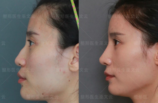 巫文云鼻修復案例