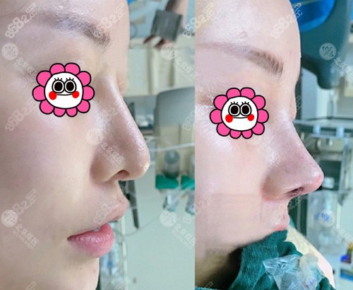 北京鼻修復王英勇和巫文云誰做得好
