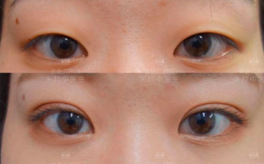 朱邦中雙眼皮案例