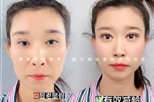魏少魁雙眼皮案例
