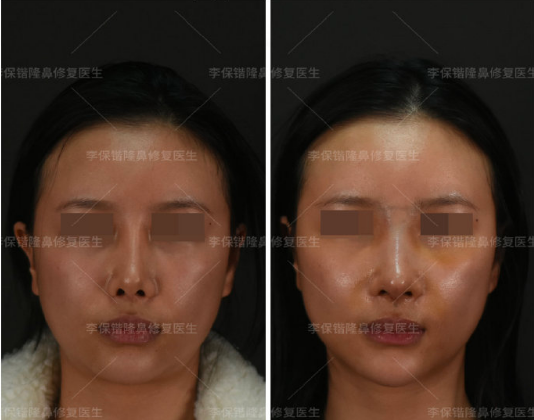 2024杭州鼻修復(fù)哪個(gè)醫(yī)生最好？