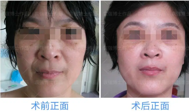 北京拉皮袁強和張海明哪個醫(yī)生好