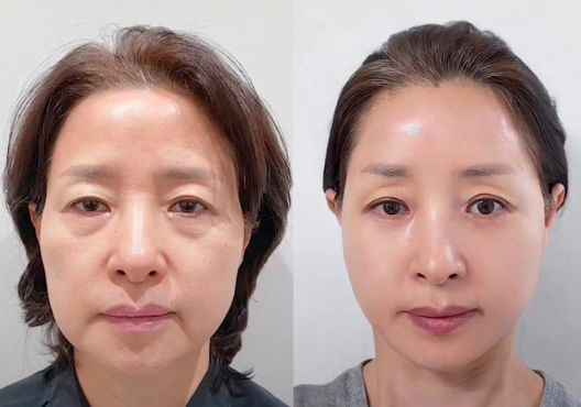 張海明拉皮手術
