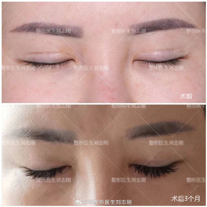 劉志剛雙眼皮修復案例