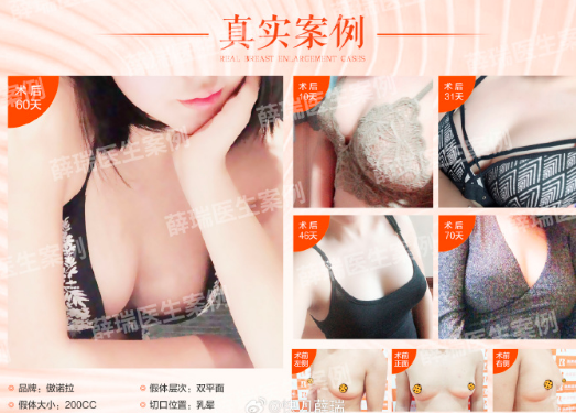 薛瑞豐胸案例