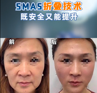 北京八大處謝洋春做拉皮手術怎么樣？