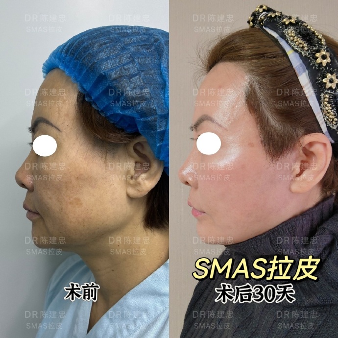 陳建忠做拉皮案例