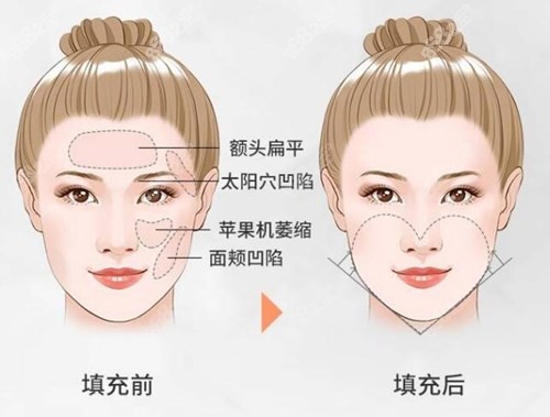 北京孫澤芳做面部脂肪填充技術怎么樣？