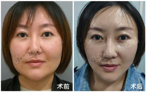 北京拉皮手術(shù)杜太超和黃寅守誰厲害
