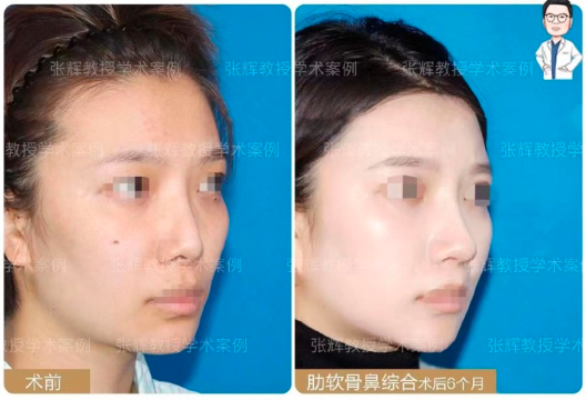 張輝鼻綜合案例