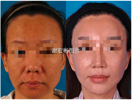 北京謝宏彬和謝洋春拉皮誰厲害