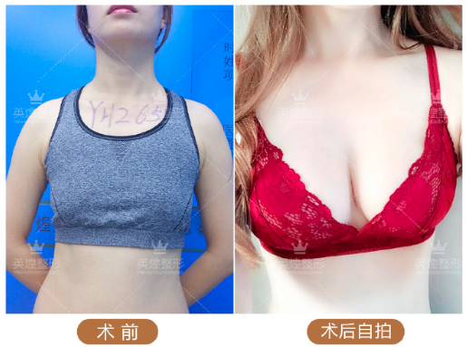 項力源自體脂肪豐胸案例