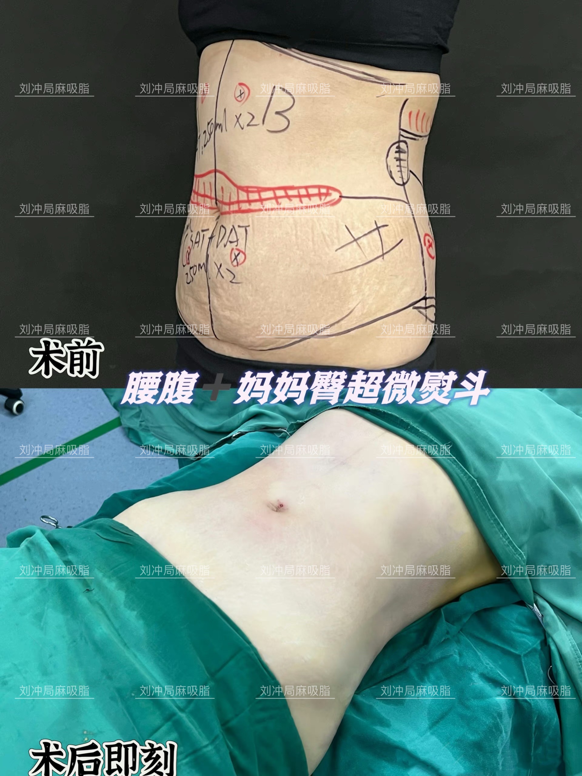 劉沖腰腹吸脂案例