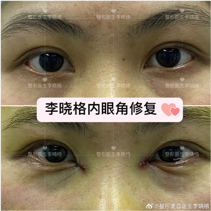 李曉格內眼角修復案例