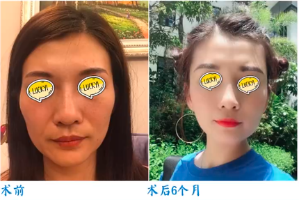 北京袁強和祝東升誰拉皮手術做的好