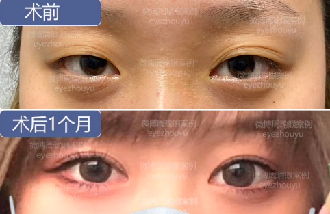 合肥周瑜和曹林做雙眼皮哪個好