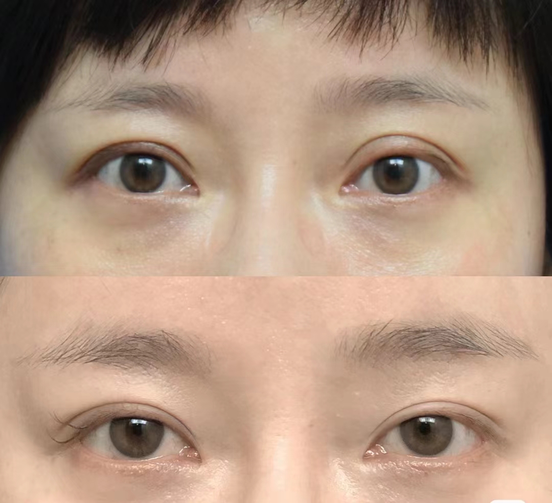 上海滕彥醫生做雙眼皮怎么樣