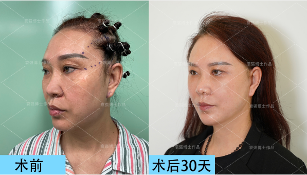 袁強拉皮案例