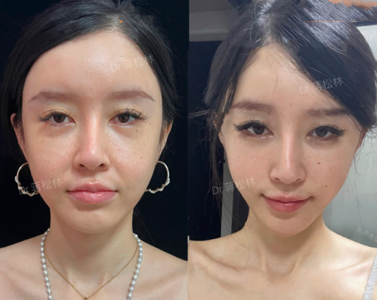 長沙蔣松林做微創拉皮技術怎么樣？