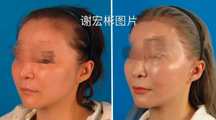 北京謝宏彬和謝洋春哪個拉皮技術(shù)好