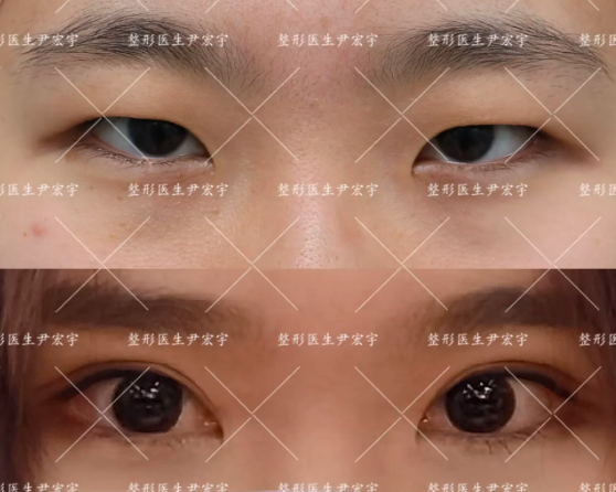 尹宏宇雙眼皮案例