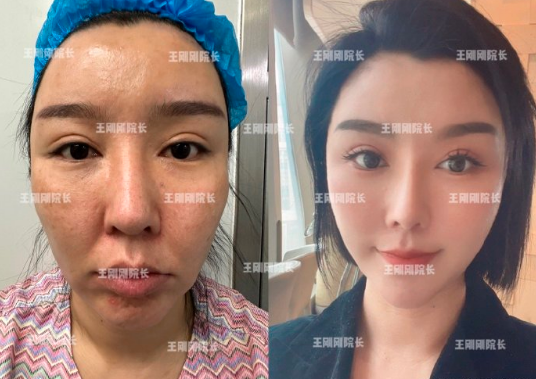 上海王剛剛做拉皮技術怎么樣