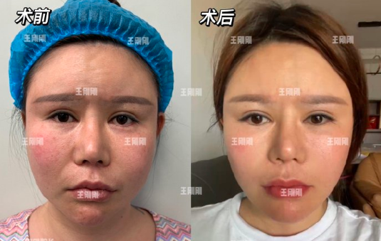 王剛剛拉皮案例