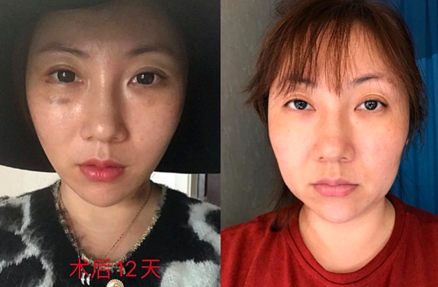上海趙寅局做拉皮技術(shù)怎么樣?