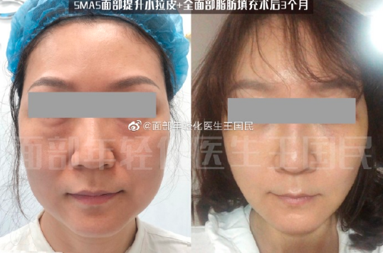 深圳王國民醫生做拉皮技術怎么樣？