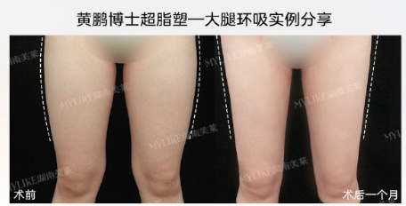 黃鵬醫生吸脂案例