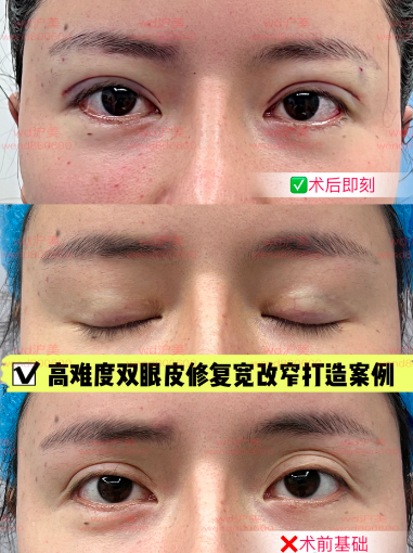 管果醫生雙眼皮修復案例