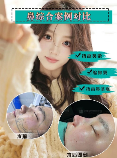 胡志成鼻綜合案例