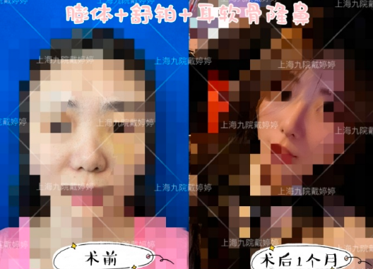 上海九院隆鼻戴婷婷和魏皎哪個好