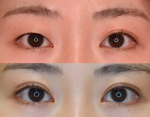 北京八大處做雙眼皮最好的醫(yī)生是誰(shuí)