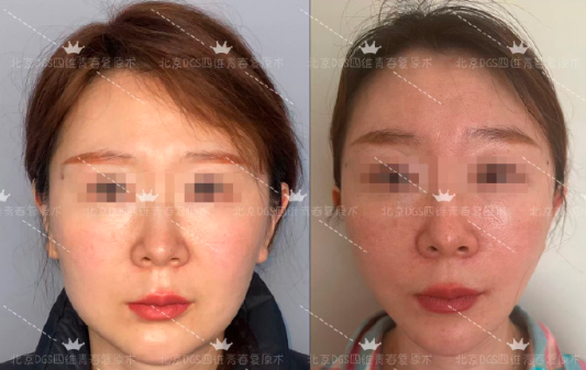 北京面部拉皮楊俊、杜太超、李曉東哪個醫生好？