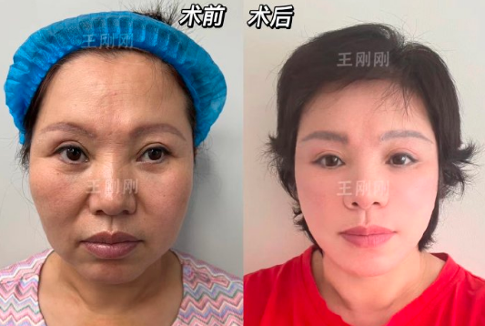 上海王剛剛做面部拉皮手術靠譜嗎？技術到底怎么樣？