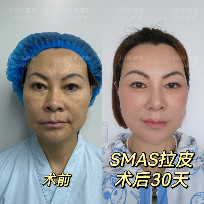 上海陳建忠做拉皮怎么樣，技術和審美好嗎？