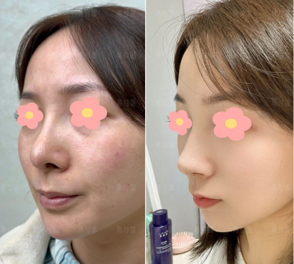 全國鼻修復醫生技術和審美哪個比較好？