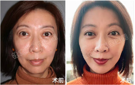 北京黃寺拉皮醫(yī)生杜太超和李曉東誰的技術(shù)好