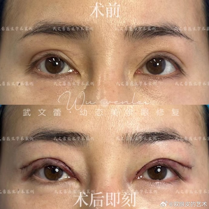 北京武文蕾修復雙眼皮怎么樣？