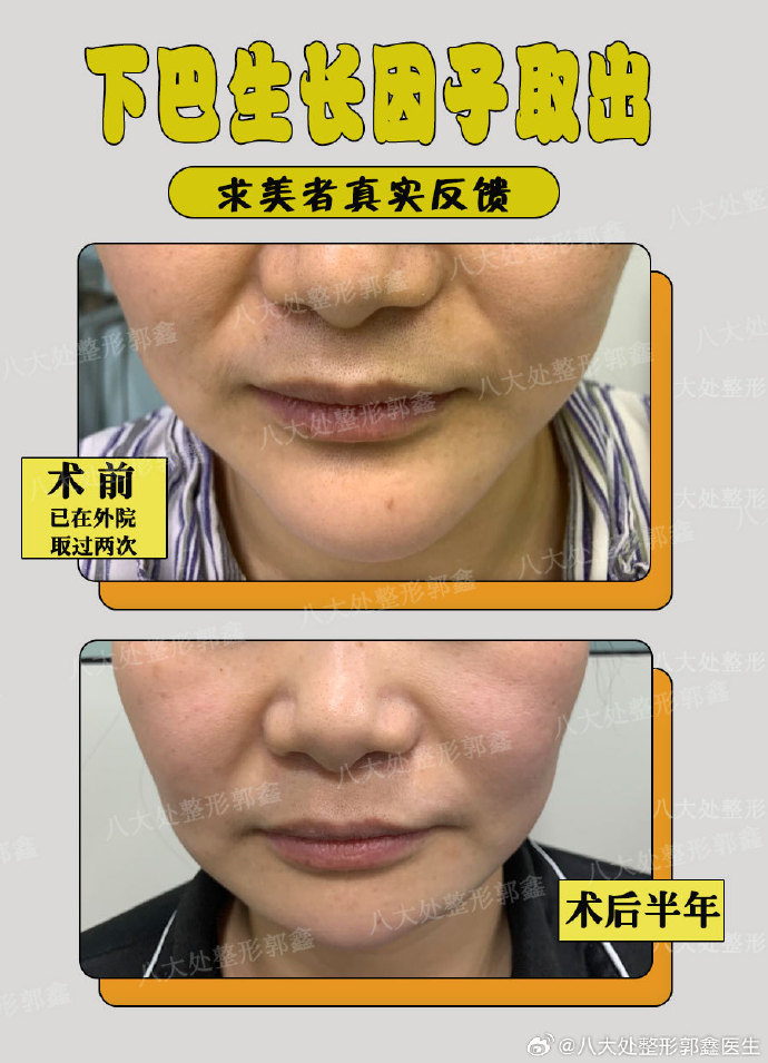 郭鑫取異物案例